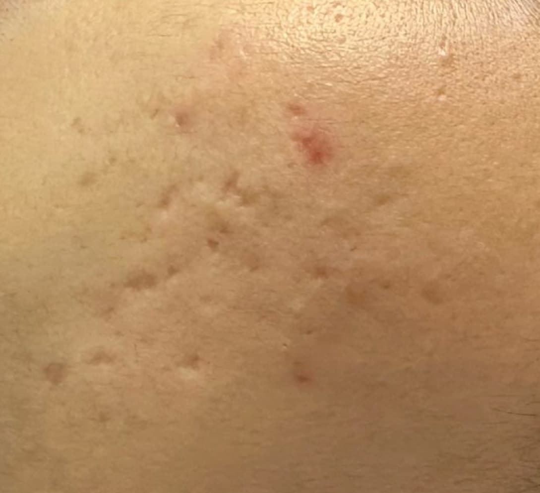 Pimples-and-Acne-post