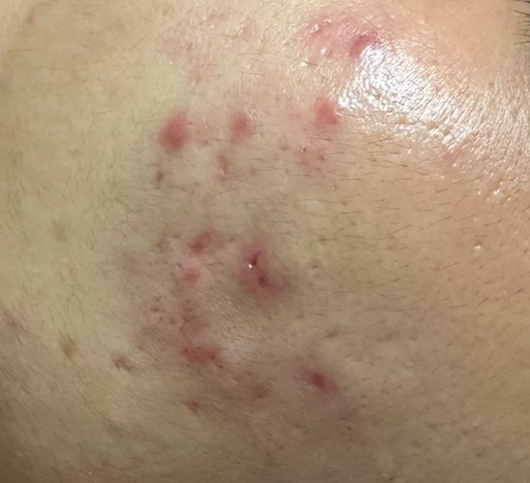 Pimples-and-Acne-pre